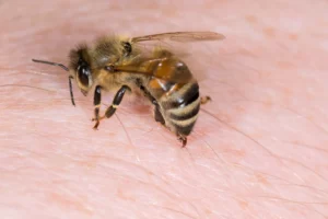 Bee Sting